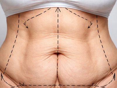 cirurgia-reparadora-bariátrica